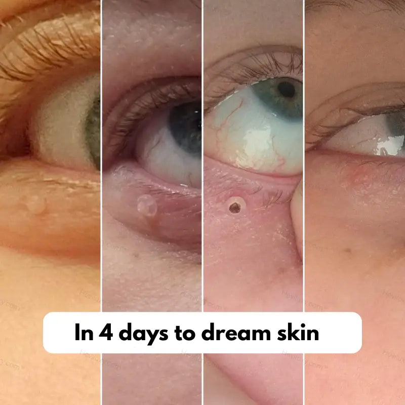 SerryLine™ Complete Set – For Skin Tag Concerns
