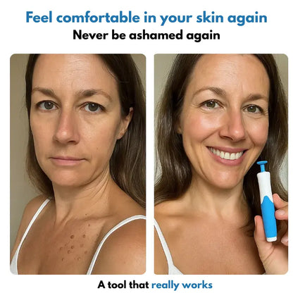 SerryLine™ Complete Set – For Skin Tag Concerns